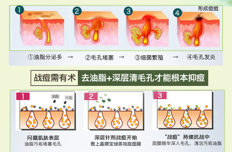 肌美精 5片装 滋润浸透面膜AD 绿茶精华 粉刺专用