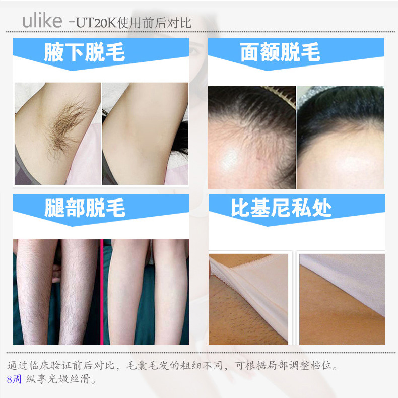 Ulike激光脱毛仪 脱毛器