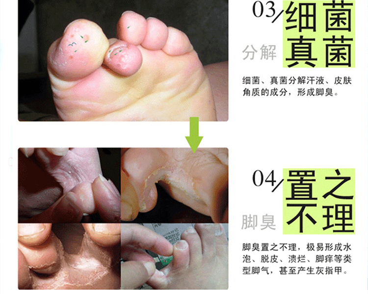 【邮储特卖】仲景脚爽喷剂 快速止痒去除脚气脚臭脚汗脚烂脚痒烂脚丫香港脚脚气王