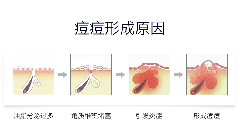 植萃集祛痘淡化去痘坑痘疤印修复凹洞芦荟胶膏产品前女五男士强