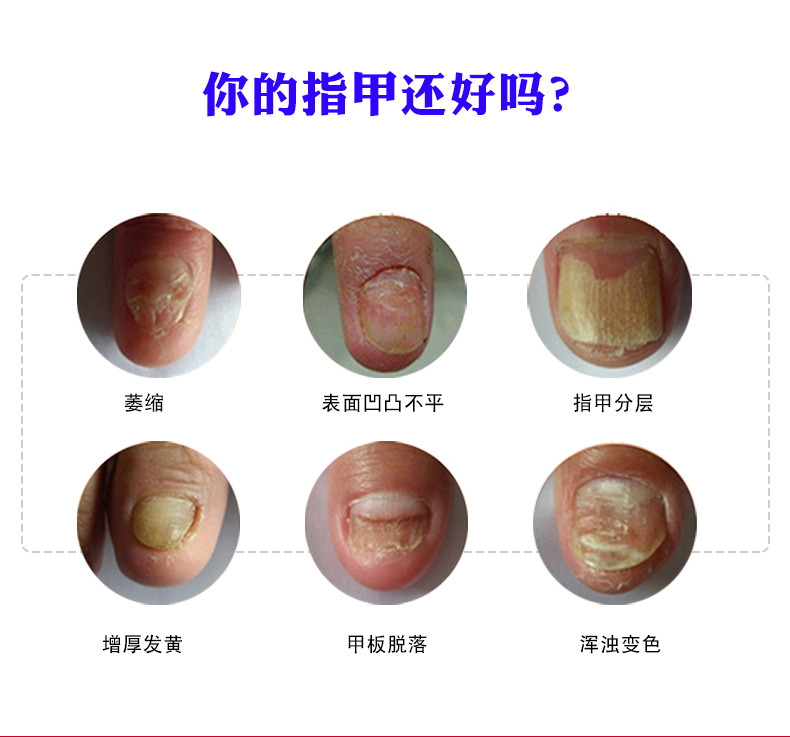 杨四郎神笔灰甲液 去灰指甲亮甲正品灰甲清指甲增厚粉尘专用脱甲软甲膏修甲液