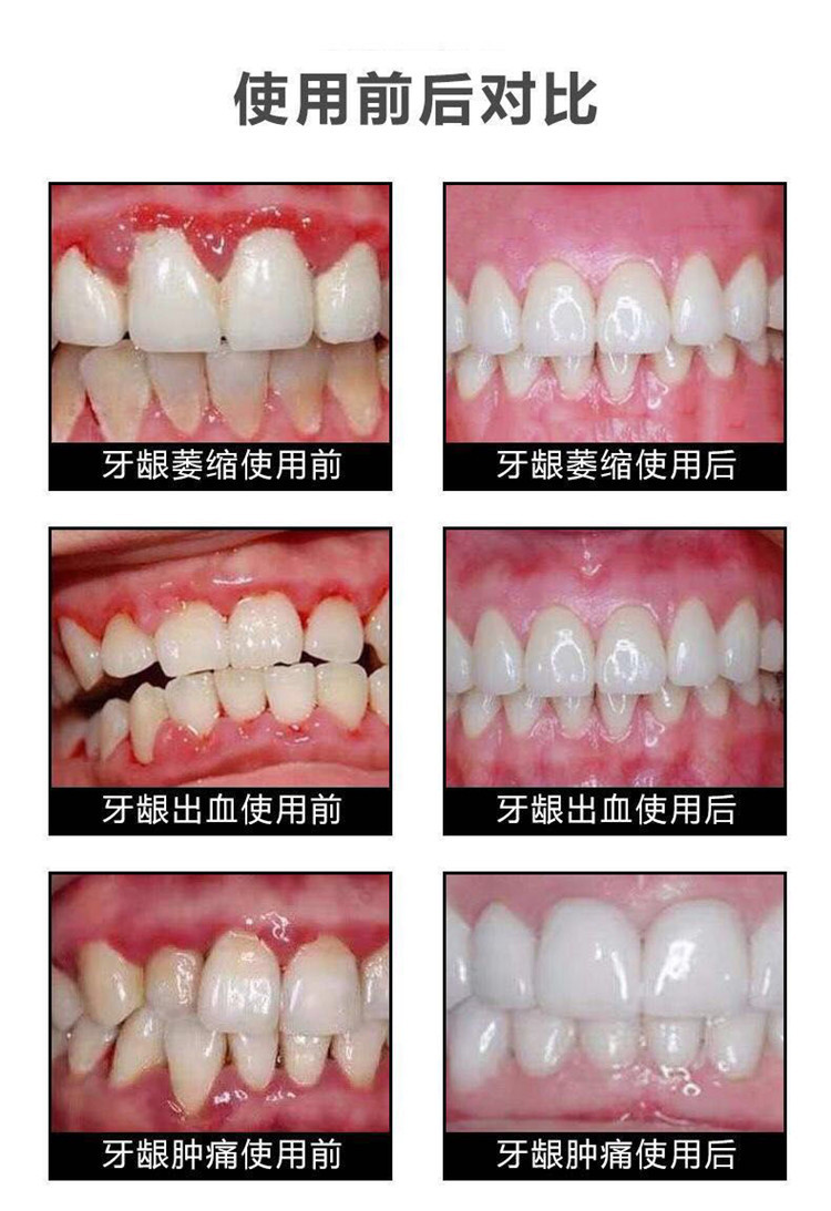 【正品大医生止血止痛强功效】洁白健齿防蛀牙膏龋齿修复去黄去口臭牙龈出血牙痛抗敏亮白