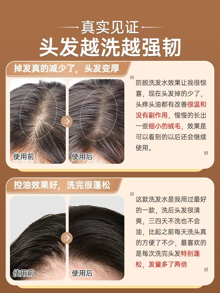 【防脱洗发水】大品牌专业防脱效果有保证生发密发控油清爽去屑止痒男性秃顶脂溢性脱发女性产后脱发白发转黑